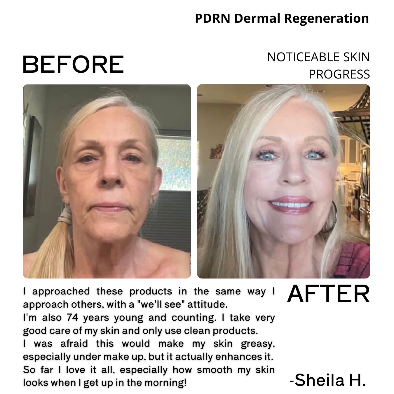 Before and after comparison of skin with text about PDRN Dermal Regeneration and a testimonial.